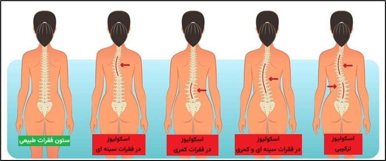 اسکولیوز چیست؟ - کلینیک امید