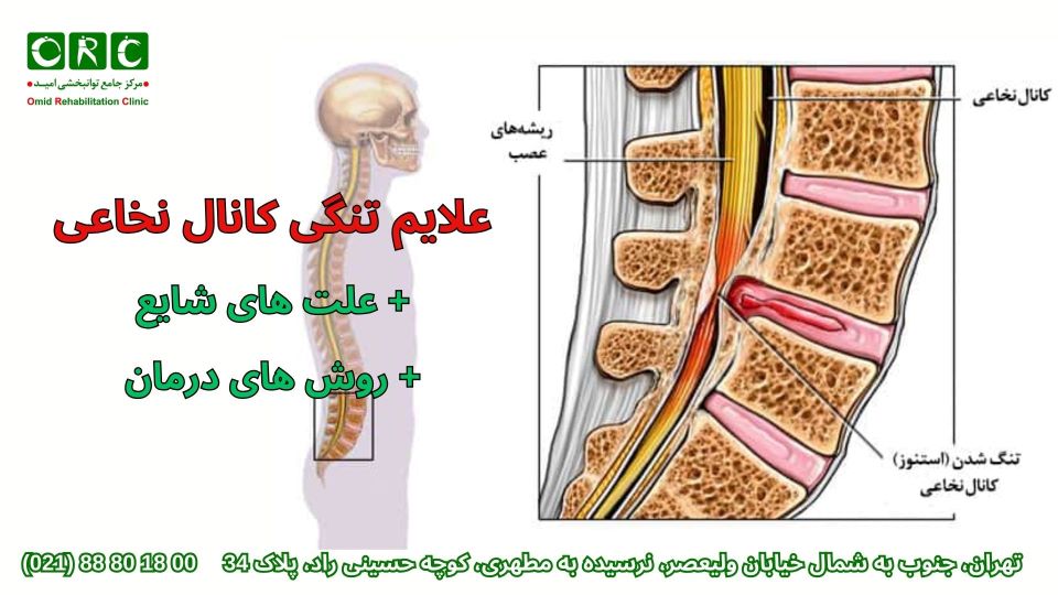 روش های درمان تنگی کانال نخاعی