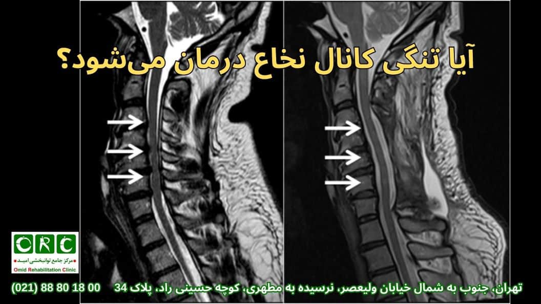 درمان غیرجراحی تنگی کانال نخاعی