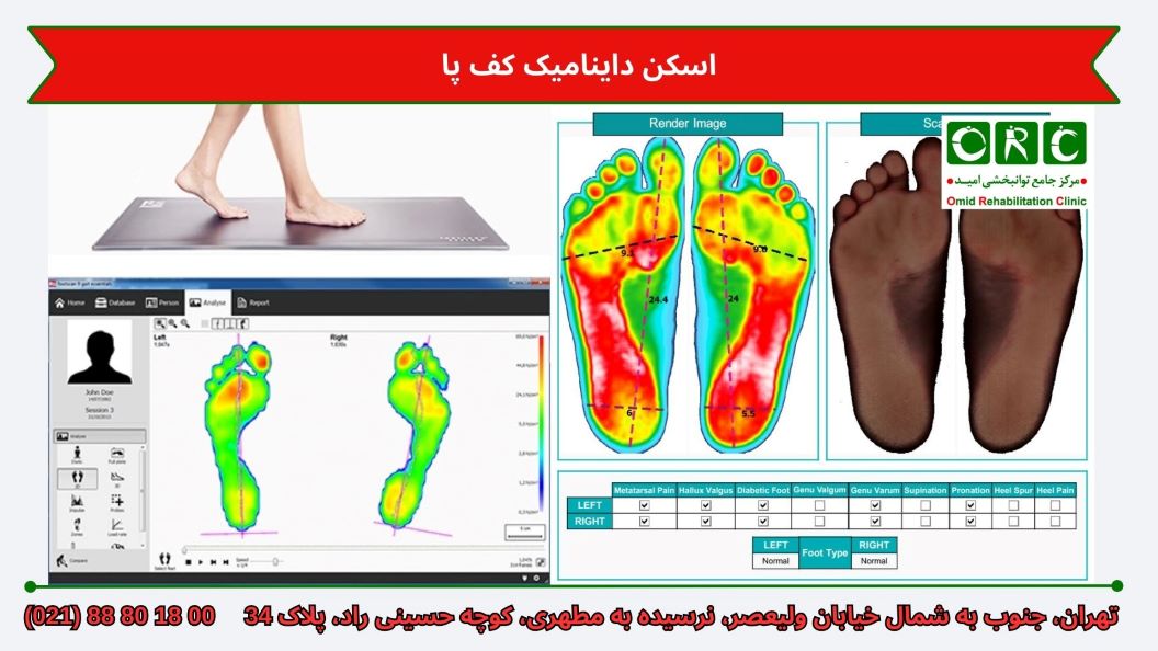 اسکن داینامیک کف پا