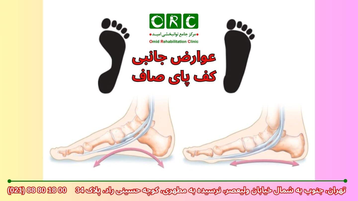 حرکات اصلاحی برای کف پای صاف