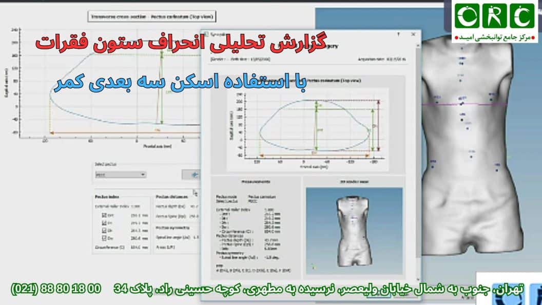 اسکن سه بعدی ستون فقرات