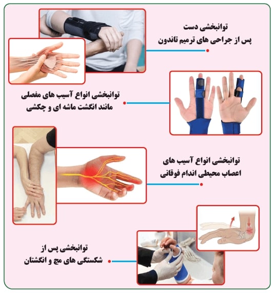 توانبخشی دست پس از عمل تاندون