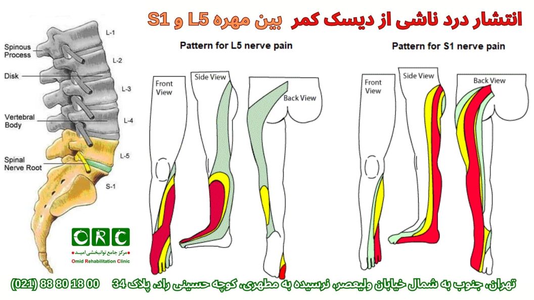 روش های درمان دیسک کمر مهره 1 و 5