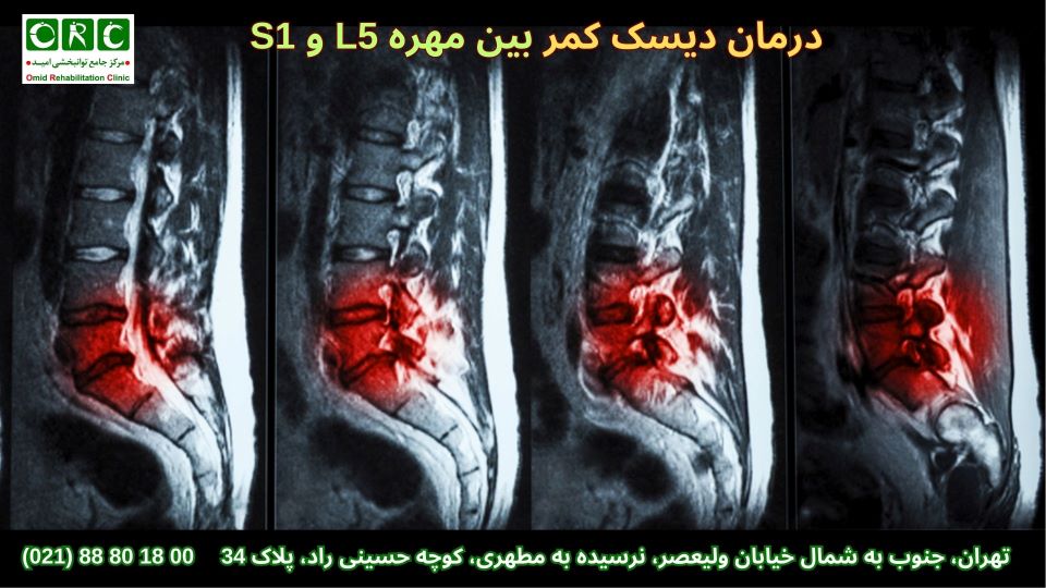 روش درمان دیسک کمر مهره 1 و 5