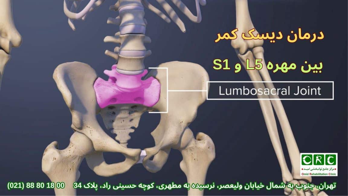 درمان دیسک کمر بین مهره 1 و 5