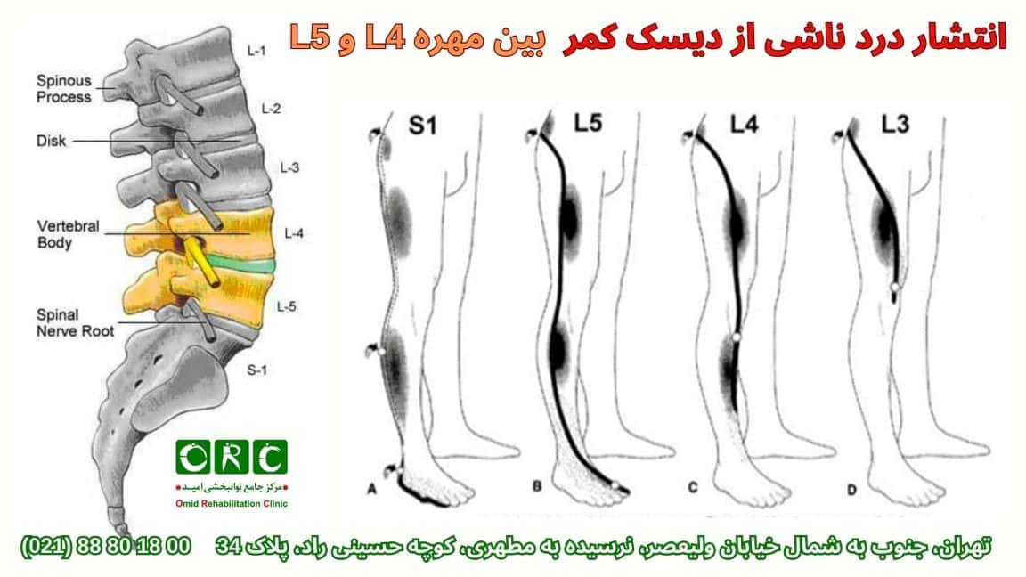 دیسک کمر مهره 4 و 5