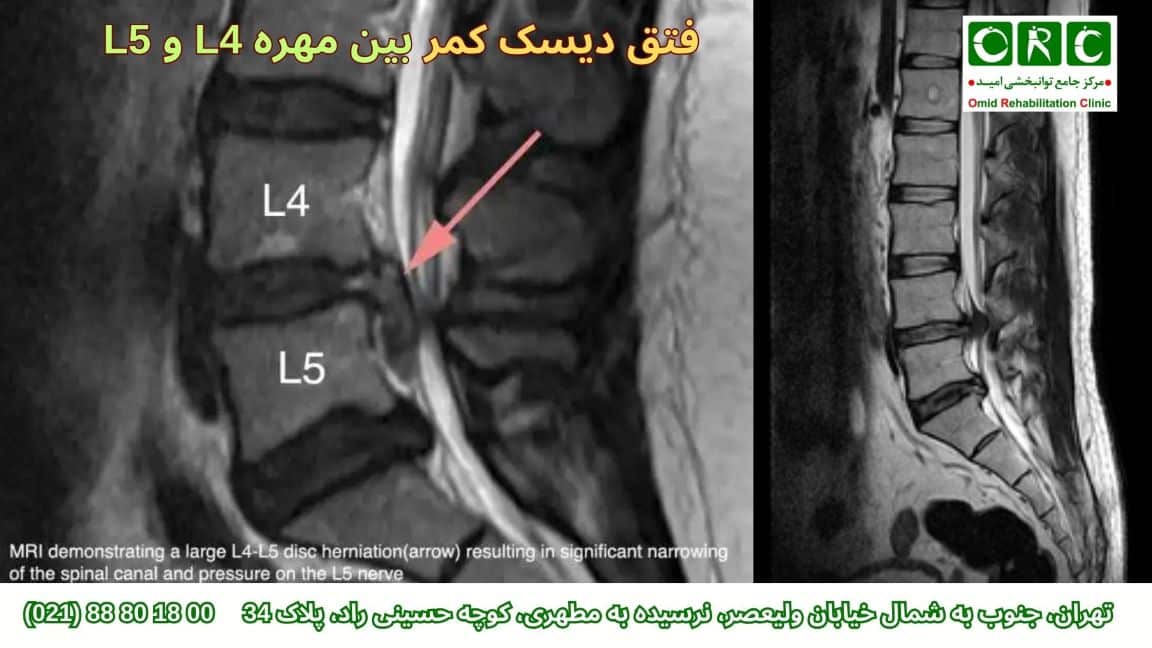 روش های درمان دیسک کمر مهره 4 و 5