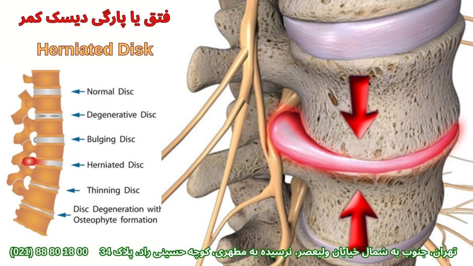 پارگی دیسک کمر