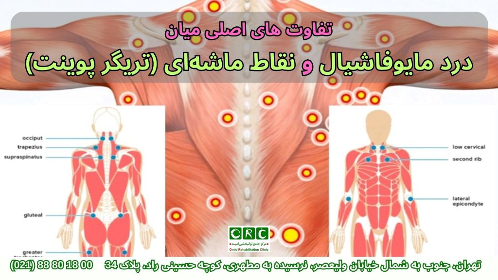 درمان سندرم درد مایوفاشیال