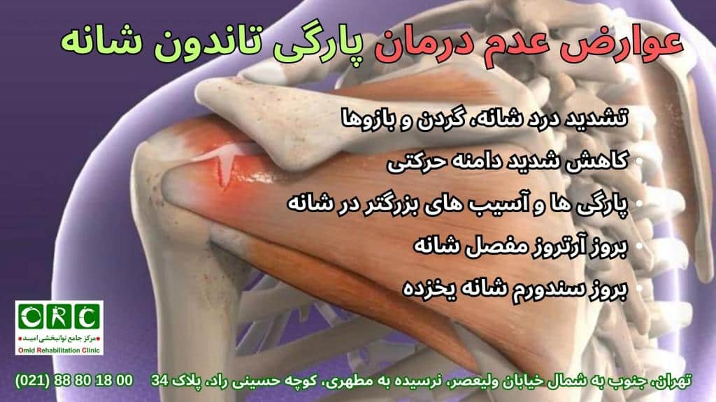 پارگی تاندون شانه چیست