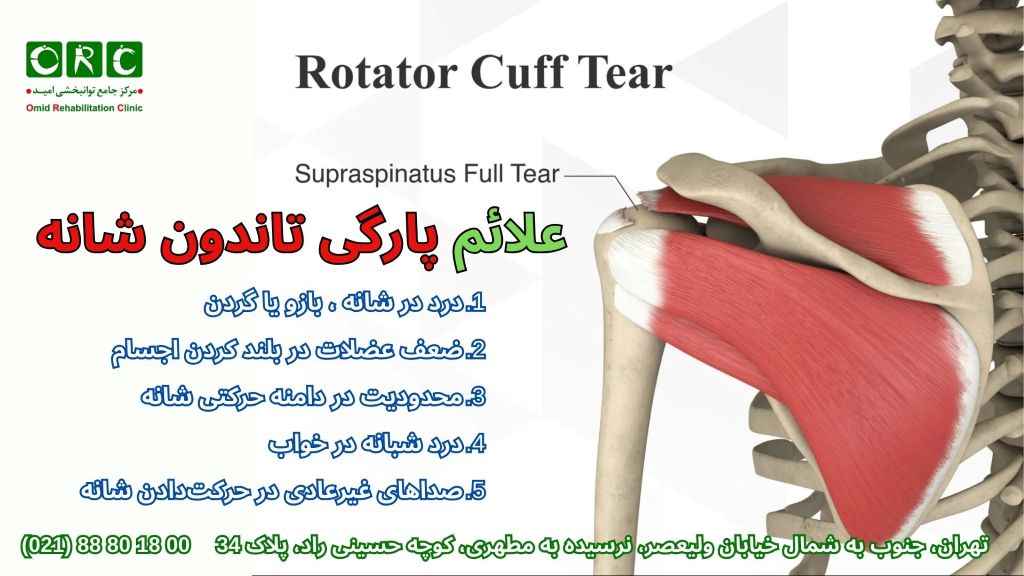رفع پارگی تاندون شانه