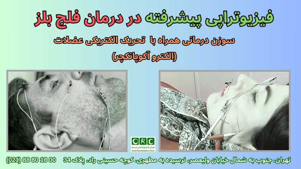 روش فیزیوتراپی فلج بلز