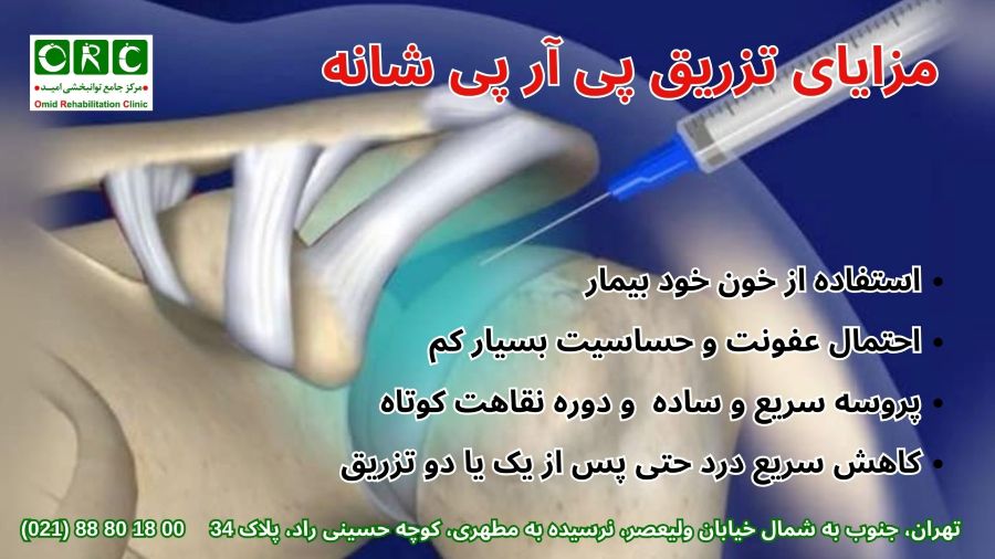 تزریق پی.آر.پی. (PRP) در مفصل شانه مزایای تزریق پی آر پی شانه